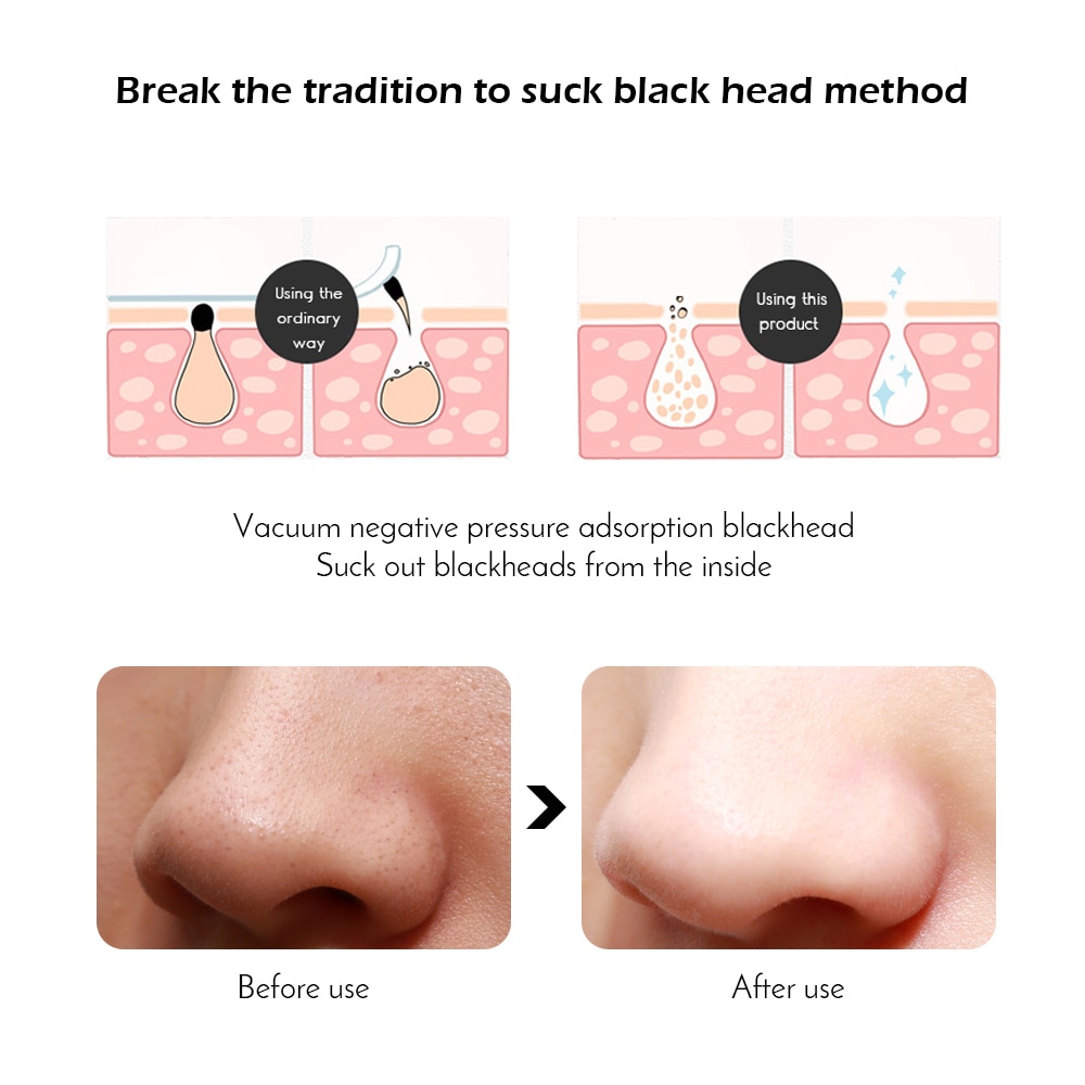 Face Acne Black Dot Pimple Blackhead Remover Electric Microcrystalline Blackhead Vacuum Cleaner Pore Blackhead Skin Care Machine